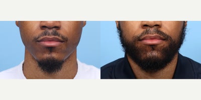 25-34 year old man treated with Beard Transplant, Hair Transplant, Hair Loss Treatment, PRP Injections, PRP for Hair Loss - This patient wanted to fill in the sparse area of hair around his lips. Dr. Wise performed an FUE hair transplant, placing 2,550 grafts to the beard area giving the patient the results he desired.