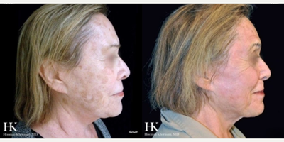 Woman treated with TotalFX - Woman treated with TotalFX
