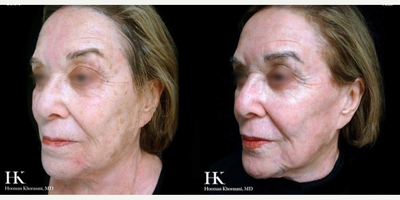 Woman treated with TotalFX - Woman treated with TotalFX