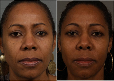 50 year old with sagging cheeks and parenthesis lines with age spots requesting non surgical treatment  - Before:  Age 46  Note of loss of youthful cheek, under eye, and jaw line volume causing drooping of the cheeks, and deepening of the parenthesis lines.  Brown age spots.  
After:  Age 50 Four years after starting Botox injections, Juvederm Liquid Lifts, and Laser Facials (brown spots).&nbsp;