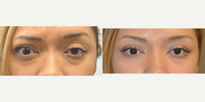 36 year old woman with Grave thyroid disease underwent orbital decompression to correct bulging eyes - 36 year old female, with Graves Thyroid Eye Disease with proptosis (bulging eyes), underwent orbital decompression surgery. Before and 3 months after oculoplastic surgery photos are shown.