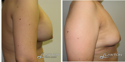 18-24 year old woman treated with Breast Implant Removal - 6 months after implant removal