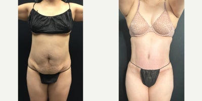35-44 year old woman treated with Diastasis Recti Repair, Liposuction - Patient received a tummy tuck with diastasis recti repair and liposuction.