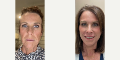 55-64 year old woman treated with Cheek Augmentation - Before and after Face/Neck lift, Laser Resurfacing, Upper and Lower Blepharoplasty, Lip Lift, Fat Transfer to Face/cheeks
