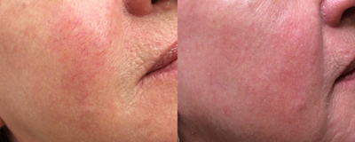 55-64 year old woman treated with Vein Treatment - This patient was treated with veingogh for the removal of the tiny little veins on the face.