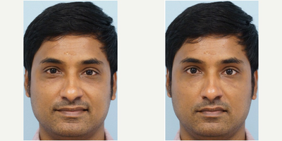 25-34 year old man treated with Restylane - He is seeking non-surgical correction with instantaneous result and minimal downtime. Hyaluronic acid filler Restylane is injected using fine cannula into the tear trough.  Lower eyelid double bubble is immediately effaced showing more refreshed appearance.