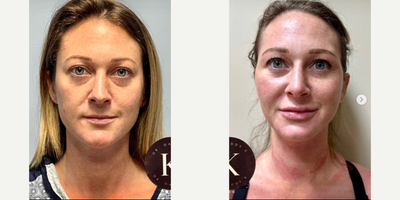 Woman treated with Renuvion - Woman treated with Renuvion