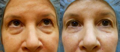 Under-Eye Filler Treatment - 
	Filler treatment reduces the aging effects of hollows under the eyes
