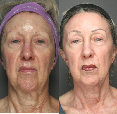 SmartSkin Laser - 	Patient requests refreshed look without surgery. Color correction, firmer skin and reduction in wrinkles greatly improves this woman's appearance.Before and 2 treatments after SmartSkin Laser resurfacing of the face and neck. Note color, texture and elasticity improvement.