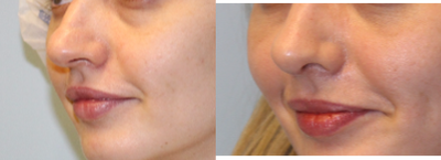 35-44 year old woman treated with Rhinoplasty - Rhinoplasty performed by Dr. Bryson Richards. Dorsal hump reduction and tip refinement.