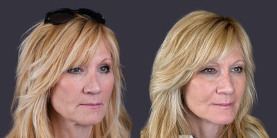 55-64 year old woman treated with Rhinoplasty, Revision Rhinoplasty, Septoplasty - This 57 year old woman is 5'11 and 185 pounds. She had a rhinoplasty about 30 years ago. She wanted to reduce and straighten her nasal bridge. She had an open rhinoplasty using septal cartilage grafts to help improve the shape to be more what she wanted.