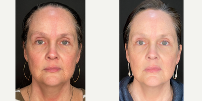 45-54 year old woman treated with Opus Plasma, Skin Tightening, Skin Rejuvenation - This is 2 weeks after having 1 Opus Plasma treatment.