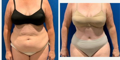 Extended Tummy Tuck with Liposuction - 55-64 year old woman treated with Tummy Tuck, Liposuction