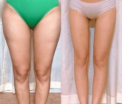 25-34 year old woman treated with Lipodissolve - Thigh liposuction
