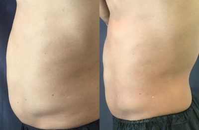 25-34 year old man treated with SculpSure - Patient was treated with Sculpure