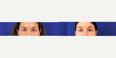 55-64 year old woman treated with Agnes RF - Upper and Lower Eyelid Tightening