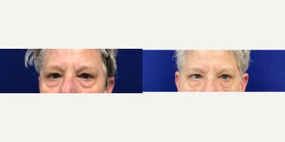 55-64 year old woman treated with Agnes RF - Upper Eyelid Tightening and Lower Eyelid debulking and Tightening
