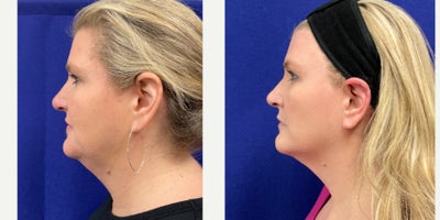 45-54 year old woman treated with Agnes RF - Submental debulking and jawline tightening