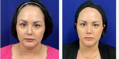 35-44 year old woman treated with Agnes RF - Submental debulking, Jowl debulking, and jawline tightening