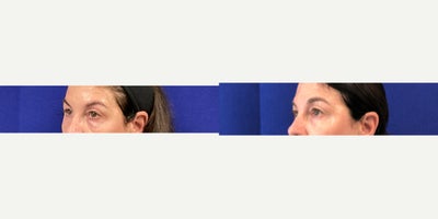 55-64 year old woman treated with Agnes RF - Upper and Lower Eyelid Tightening