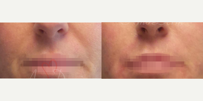 45-54 year old woman treated with Dermal Fillers, Juvederm, Radiesse, Restylane, Vollure, Bellafill - Treatment of nasolabial folds with Juvederm, Radiesse, Vollure, Restylane, Bellafill or RHA injected with cannula