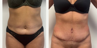 45-54 year old woman treated with Tummy Tuck - 6 weeks after an abdominoplasty and muscle tightening.