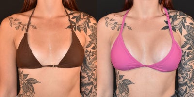 25-34 year old woman treated with Breast Augmentation, Sientra Breast Implants - 285cc Sientra Smooth Round Implants