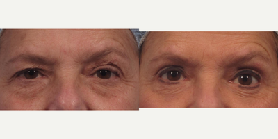 Upper eyelid lift with upper eyelid laser resurfacing - An upper eyelid lift was performed with CO2 laser resurfacing of the upper eyelid and sub-brow skin at the same time.