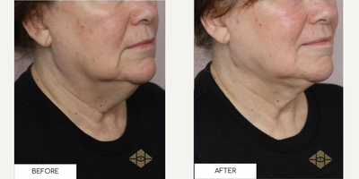 Woman treated with BeautiFill, Laser Liposuction, Microneedling RF - Woman treated with BeautiFill, Laser Liposuction, Microneedling RF