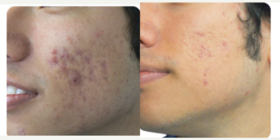 25-34 year old man treated with Spironolactone For Acne, Laser Resurfacing, CO2 Laser, YAG Laser, Fractional Laser, UltraPulse C - A safe and effective way to treat acne (even cases resistant to conventional therapies), improve the skin and minimize scar formation.What are the benefits?Laser acne treatment offers a no down-time approach to help clear acne lesions and help reduce severity of future breakouts. You can return to work or school immediately after treatment. The only side effect will be slight facial redness. Laser treatments do not have the side effects seen with oral and topical treatments. Laser treatment DO NOT induce prolonged dryness, severe redness, or mental depression.How does it work?Dr. Rafael Diaz-Yoserev will analyze your skin condition and help you select the most effective treatment for you.When will you see results?Effects are cumulative. After the first treatment, you might see improvements. The number of lesions and severity of breakouts should reduce over the course of treatments and beyond. Some patients continue to improve two months after their last treatment.How often can you have it done?The typical course of treatments is 2-3 weeks, 2-3 treatments per week.