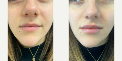 18-24 year old woman treated with Volbella - Immediately after 1/2 syring of volbella to the lips done by PA Steve.