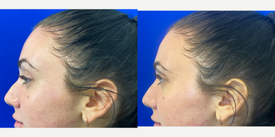 18-24 year old woman treated with Nonsurgical Nose Job - Immediately after using Restylane lyft to the nose to straighten the dorsal bump by PA Steve.