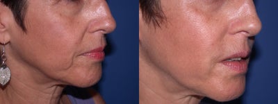 Before & After Perlane to the nasolabial folds - This woman requested improvement to her nasolabial folds, but was not interested in surgery.  I utilized Perlane to fill the nasolabial folds, which provided her a very nice, soft result.