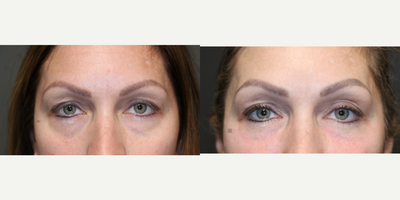 Tear Trough Filler - Tear trough filler and cheek augmentation with cannula.