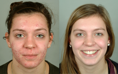 22 year old woman treated with Accutane - 22 year old woman with severe acne, showing baseline and 10 months following completion of our aggressive treatment approach.