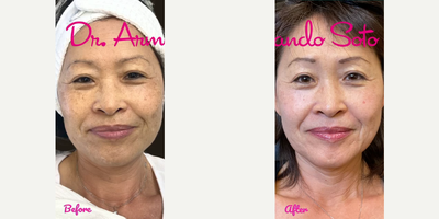 Woman treated with Moxi - After just ONE of my Moxi laser treatments here at my office, I was able to greatly improve the tone and texture of her skin. She is shown before and only 2 weeks after.