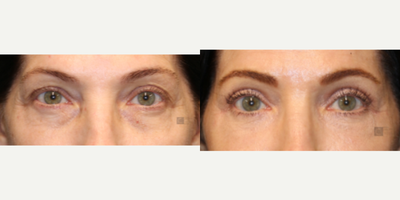 Enigmalift Upper and Lower Eyelid Surgery - Enigmalift upper and lower eyelid surgery with laser resurfacing and fat transfer.