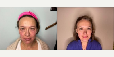 Woman treated with Neo Laser - NeoGen PSR, 2 months post treatment