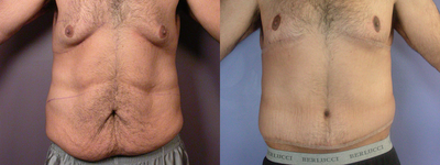 After Weight Loss - 
	After weight loss (case 2340)
