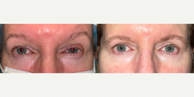 55-64 year old woman treated with Ptosis Surgery, Eyelid Surgery - 2.5 years since patient had upper blepharoplasty and ptosis surgery. Longstanding results.