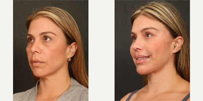 35-44 year old woman treated with Neck Lift, Eyelid Surgery, Brow Lift, Chin Implant - performed by Dr.Sozer