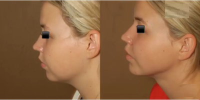 Woman treated with Buccal Fat Removal - Woman treated with Buccal Fat Removal