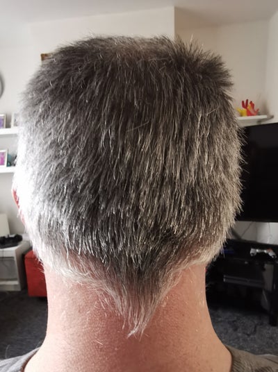 Fue Treatment In Istanbul Elithairtransplant Review Realself