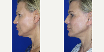 Woman treated with Nonsurgical Facelift, Nonsurgical Neck Lift - This beautiful patient came to us seeking facial rejuvenation to reverse signs of aging. We performed a FaceologyLIFT which significantly lifted her neckline, tightened her skin, and redefined her jawline.This procedure is done under local anesthesia, with a small incision that is hidden along the hairline and margins of the ear, allowing a rapid and easy recovery.