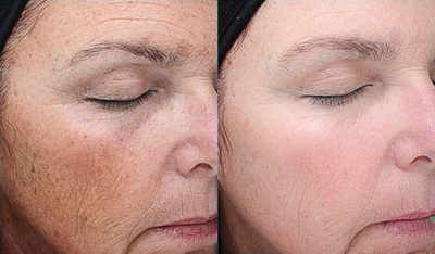 VI Peel - The aging process can cause your skin to become lax, pigmented and rough. Sun exposure and environmental assault just adds to the problem. Aging is inevitable but the VI Peel can make a difference in as little as 7 days