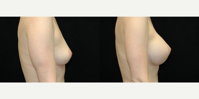 25-34 year old woman treated with Mentor Breast Implants - Moderate Plus Saline Mentor Implant 325-390, 325cc, inframmary crease incision