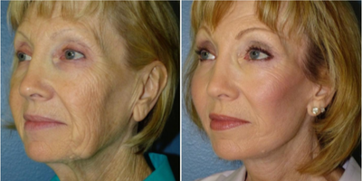 71 year old woman treated with CO2 Laser - 71 year old woman treated withCO2 Laser as well asSMAS Facelift,Neck Lift, andFacial Fat Transferto treat laxity, volume depletion, and texture for overall facial rejuvenation. She is shown before and 6 months post op.