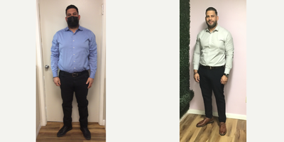 35-44 year old man treated with Endoscopic Sleeve Gastroplasty - Our patient lost a total of 36 Lbs in 18 months after his Endoscopic Sleeve Gastroplasty procedure. The patient reached his goal weight within the first six months and has maintained it ever since.
