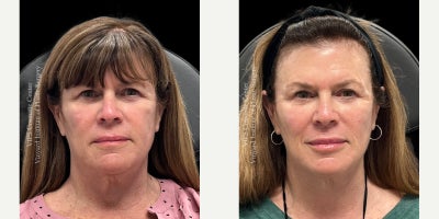 55-64 year old woman treated with Cheek Fillers, Morpheus8 Microneedling RF, Lip Fillers, Juvederm - After her facelift with Dr. Vinyard, this patient enhanced her results with Morpheus8 RF microneedling to smooth skin and boost collagen, plus Juvederm Voluma in the cheeks and Juvederm Ultra in the lips to restore youthful balance and contour.