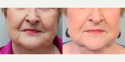 65-74 year old woman treated with Restylane - This patient had her peri-oral area softened with Restylane
